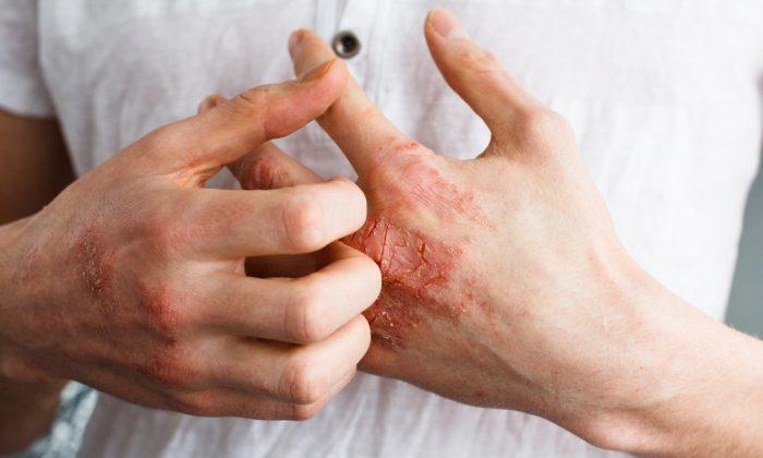 Living with Eczema: Treatment Options and Mental Health Impacts