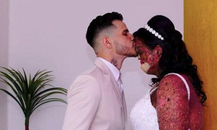 Woman With Rare Skin Disease Finds True Soulmate: ‘Love Exists, Believe Me!’