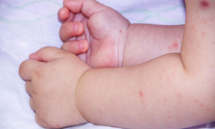 6-Month-Old Baby Girl Infected by Herpes Despite Protective Mom’s Kiss Ban