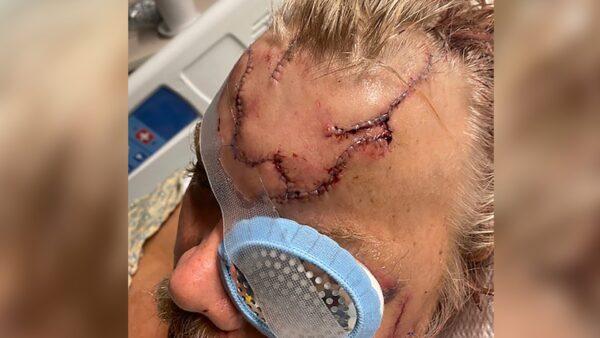 Lacerations on Allen Minish's head as he recuperates at a hospital in Anchorage, following a mauling by a brown bear, Alaska, on May 18, 2021. (Courtesy of Allen Minish via AP)