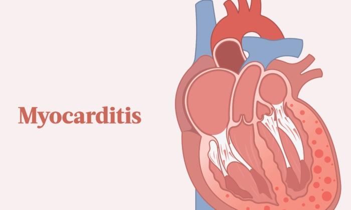 The Essential Guide to Myocarditis: Symptoms, Causes, Treatments, and Other Remedies