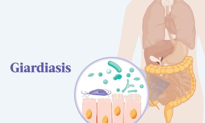 The Essential Guide to Giardiasis: Symptoms, Causes, Treatments, and Natural Approaches