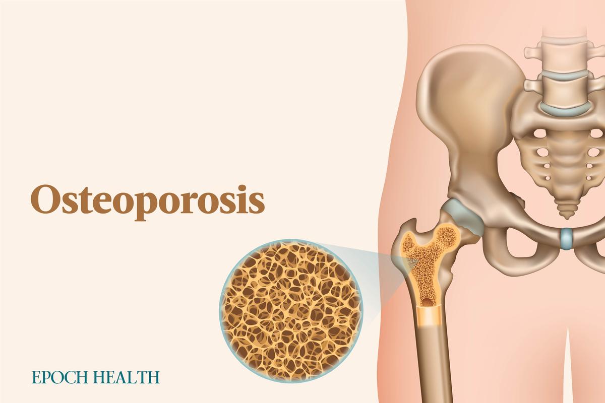 The Essential Guide to Osteoporosis: Symptoms, Causes, Treatments, and Natural Approaches