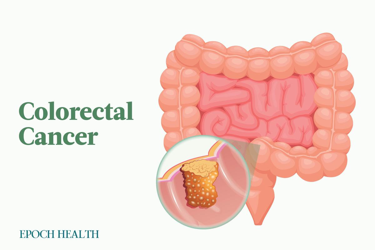 The Essential Guide to Colorectal Cancer: Symptoms, Causes, Treatments, and Natural Approaches 