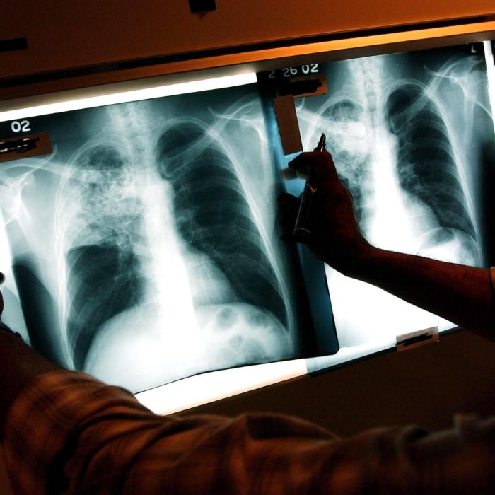 Emergency Declared on Tuberculosis in California City: What to Look For