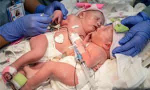 Happy Homecoming for Conjoined Twins After a Complex 6-Hour Separation Surgery