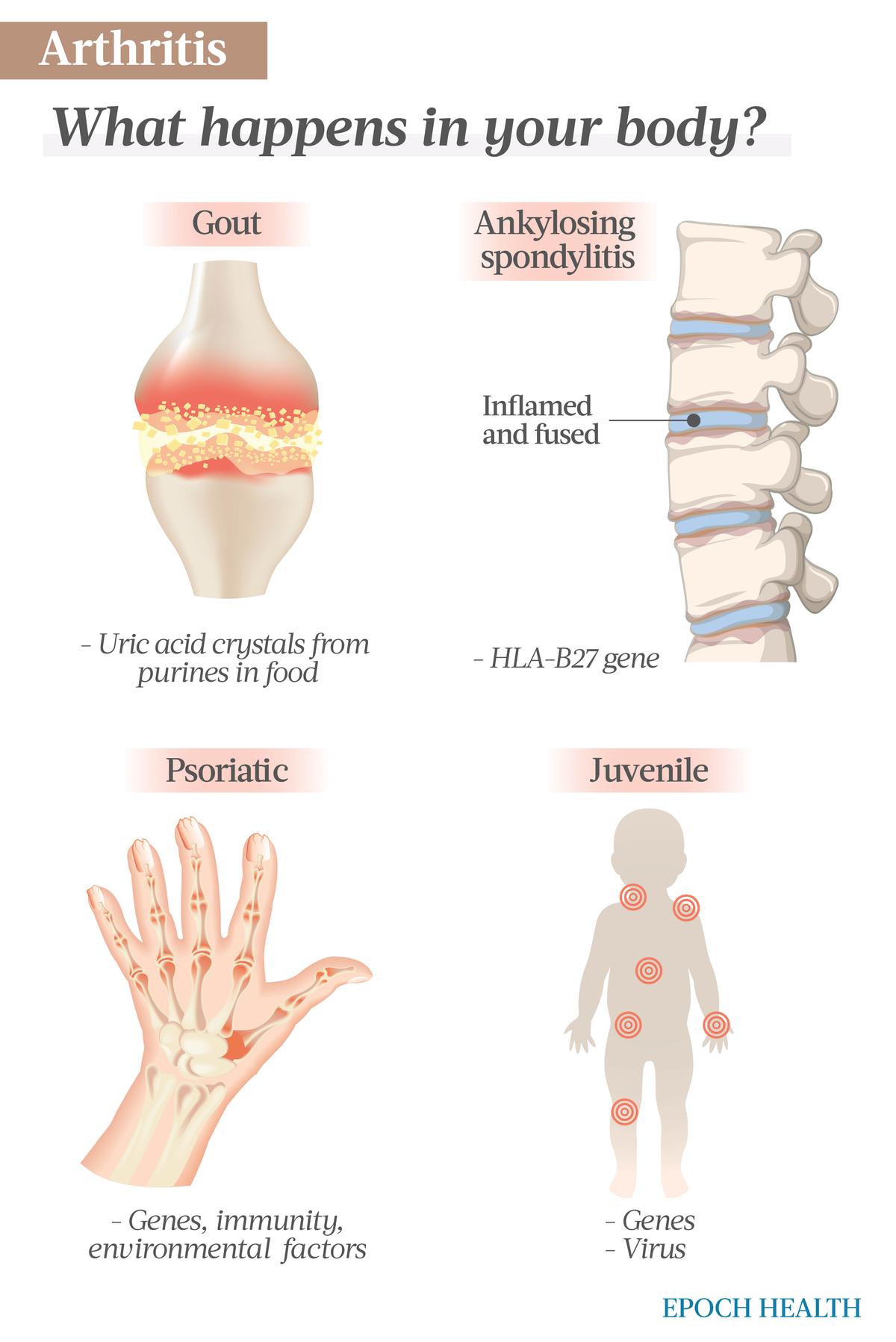  Gout, ankylosing spondylitis, juvenile arthritis, and psoriatic arthritis are only a few of the many types of arthritis. (The Epoch Times)