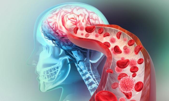 Risk of Stroke Skyrockets With COVID-19 Infection After Vaccination