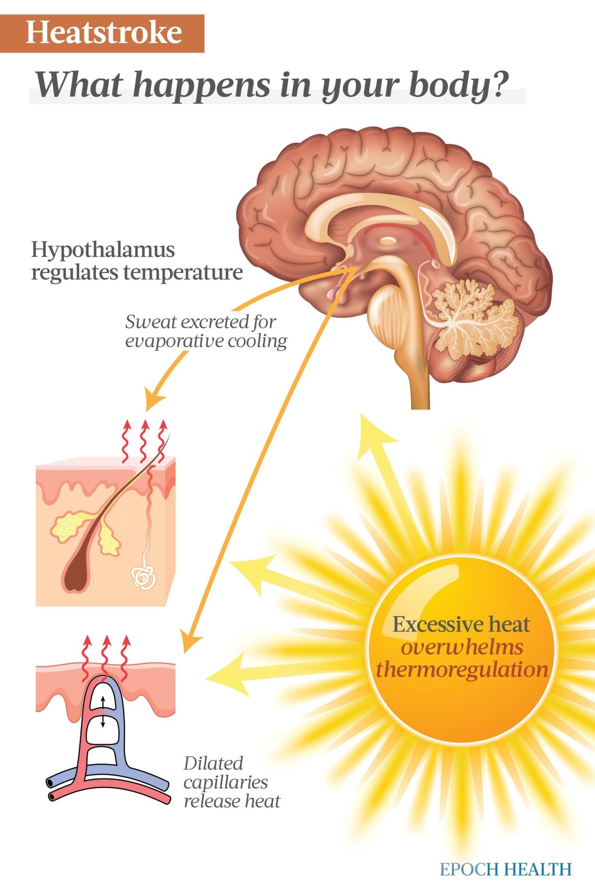  The hypothalamus oversees thermoregulation. When body temperature rises, the brain triggers the skin's sweat glands to excrete sweat and its capillaries to dilate to release heat in an effort to cool the body. When the heat becomes excessive, whether from the environment or exertion, the system becomes overwhelmed and fails, resulting in heatstroke. (The Epoch Times)