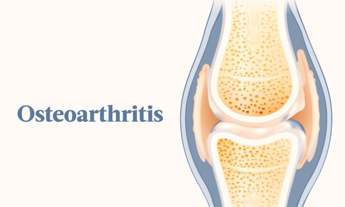 The Essential Guide to Osteoarthritis: Symptoms, Causes, Treatments, and Natural Approaches