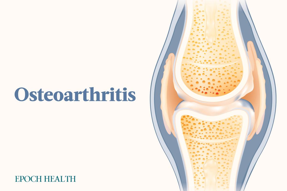 The Essential Guide to Osteoarthritis: Symptoms, Causes, Treatments, and Natural Approaches