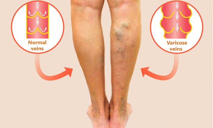 Wondering What to Do About Varicose Veins? Traditional Chinese Medicine Has Solutions