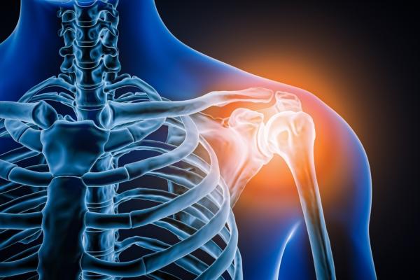 Frozen Shoulder: An Inflammatory Condition and 6 Top Exercises for Relief
