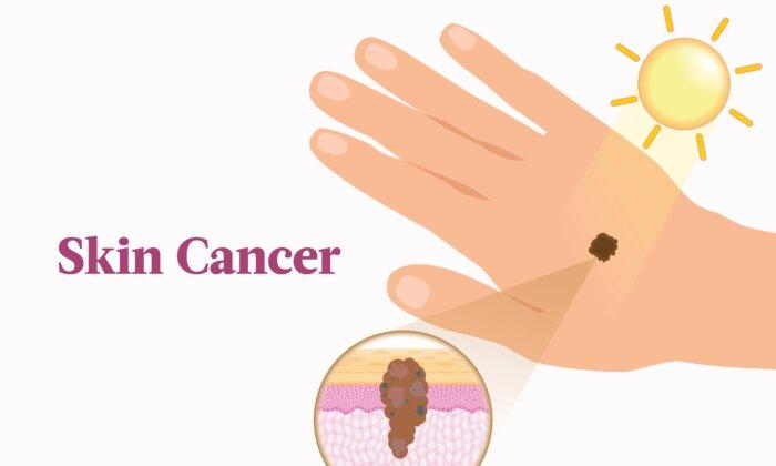 The Essential Guide to Skin Cancer: Symptoms, Causes, Treatments, and Natural Approaches