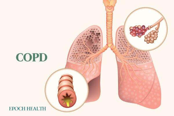 The Essential Guide to COPD: Symptoms, Causes, Treatments, and Natural Approaches
