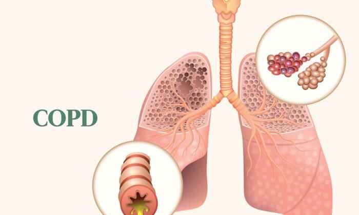 The Essential Guide to COPD: Symptoms, Causes, Treatments, and Natural Approaches