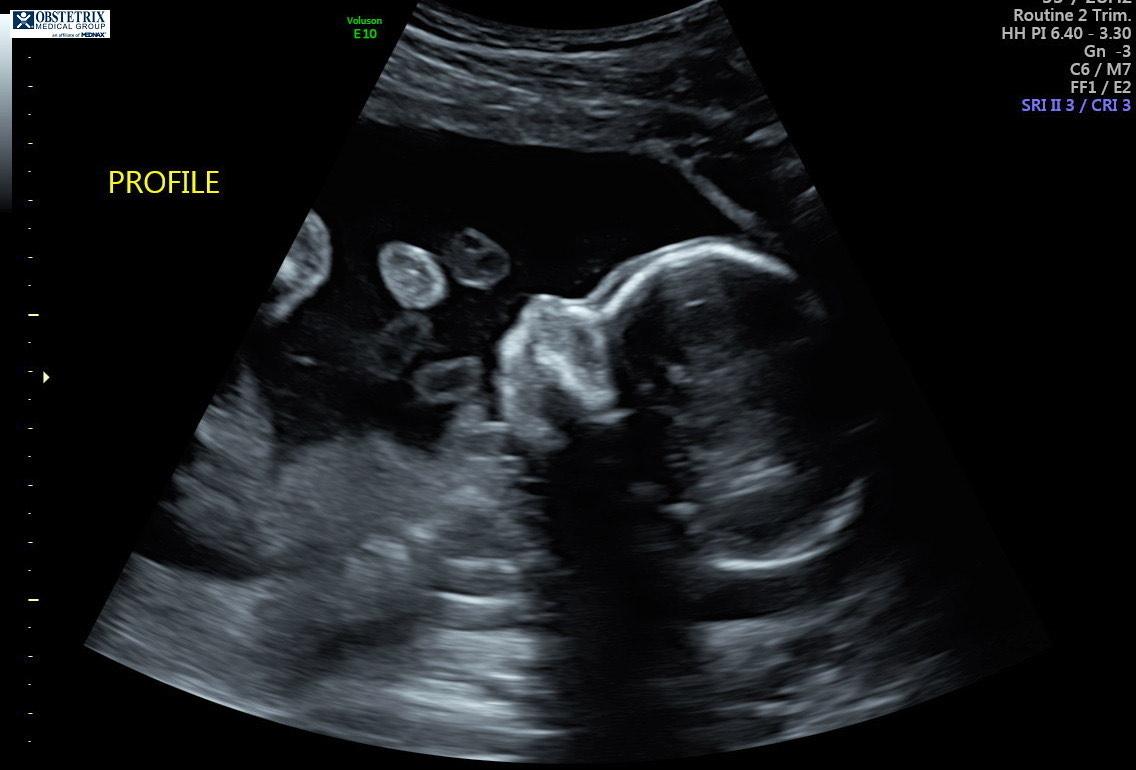 An ultrasound image of Ms. Howard's fetus. (Courtesy of Gemma Howard)