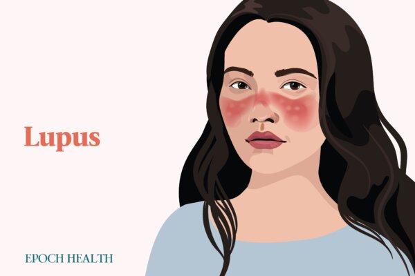 The Essential Guide to Lupus: Symptoms, Causes, Treatments, and Natural Approaches