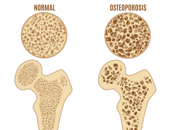 Guarding Against Osteoporosis: Unveiling Risk Factors and Time-Honored Prevention Methods