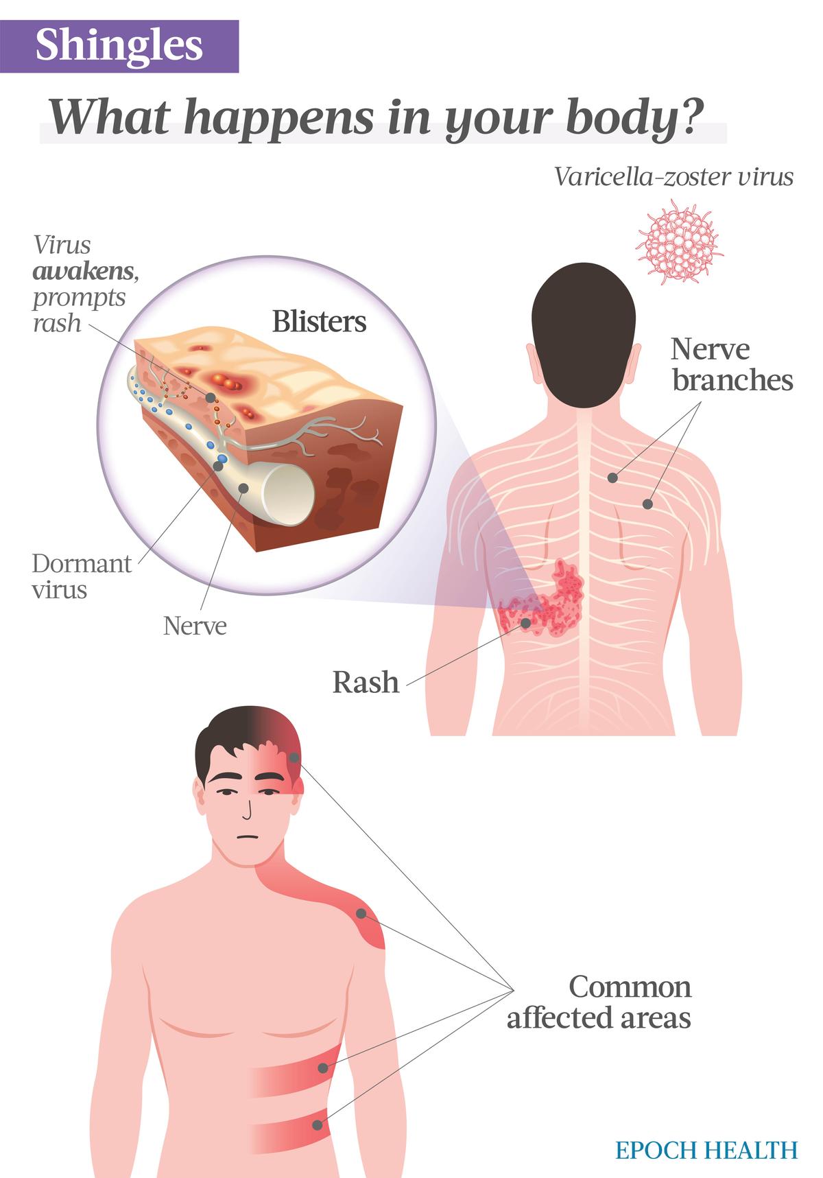  Shingles is caused by the chickenpox virus that affects nerves. After one develops chickenpox, the virus remains dormant in the body and may reactivate due to a weakened immune system. If it reactivates, it results in shingles. (Illustrations by The Epoch Times, Shutterstock)