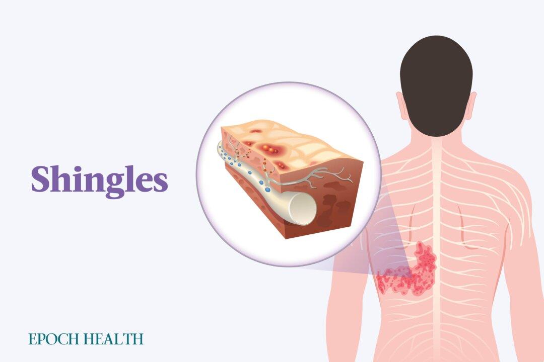 The Essential Guide to Shingles (Herpes Zoster): Symptoms, Causes, Treatments, and Natural Approaches