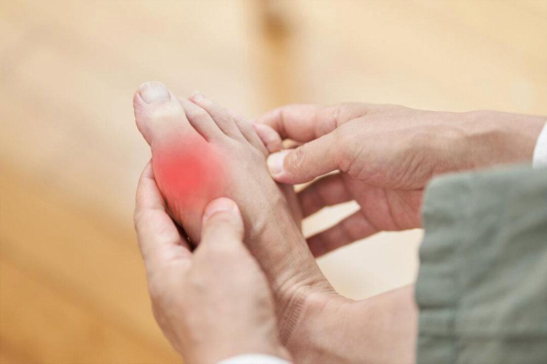 How to Prevent and Manage Painful Gout Attacks