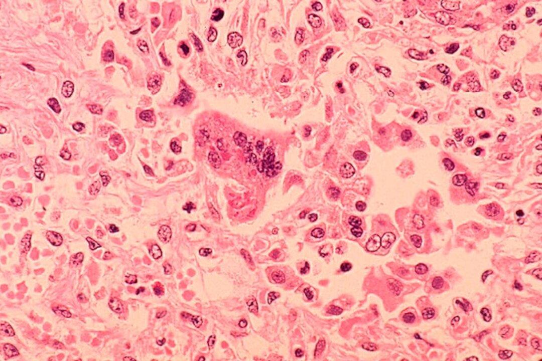 Measles Cases Spread at South Florida Elementary School