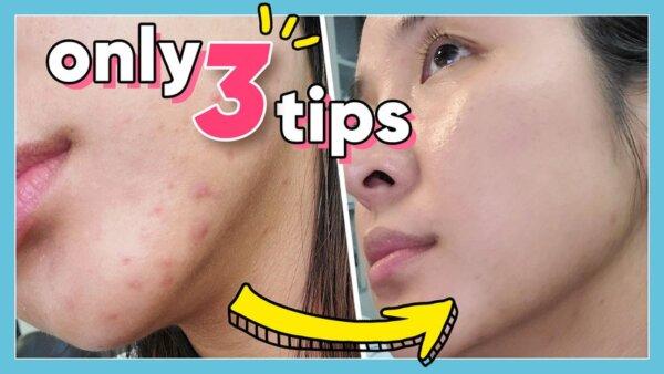 It’s Im-Pore-Tant! 3 Quick & Simple Ways to Get Rid of Pimples!
